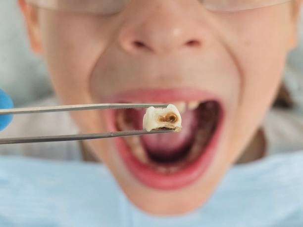 Best Emergency Dental Care for Abscessed Tooth in Montague, CA